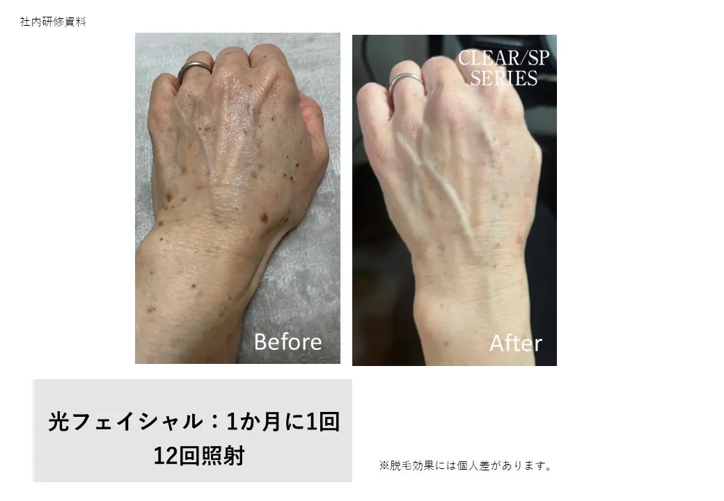 光フェイシャル