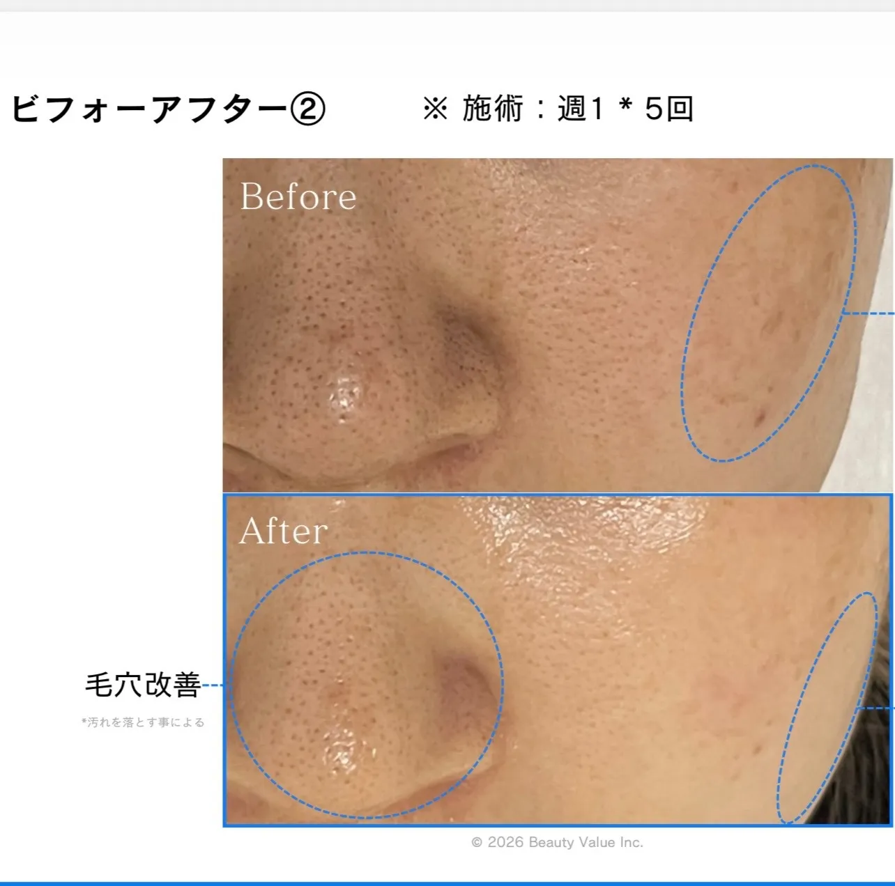 (本気で肌の悩み解決したい方へルフレの艶肌ピーリング)